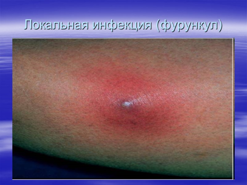 Локальная инфекция (фурункул)